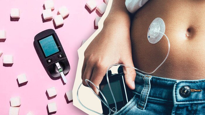 Desarrollan páncreas artificial que podría eliminar inyecciones diarias de insulina en pacientes con diabetes tipo 1