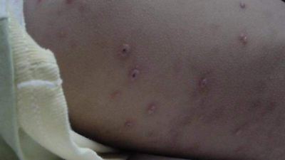 Edomex lidera contagios de varicela en México en 2025