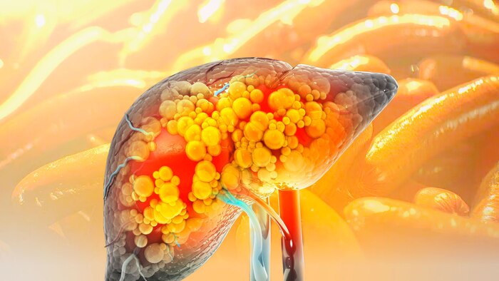 Efectos del consumo de embutidos en personas con hígado graso