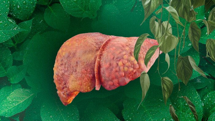 Hígado graso y cirrosis: la planta melisa como aliada natural para su prevención