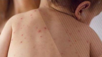 Incrementan muertes por sarampión en Chihuahua; último caso fue de mujer y bebé indígenas en Guadalupe y Calvo